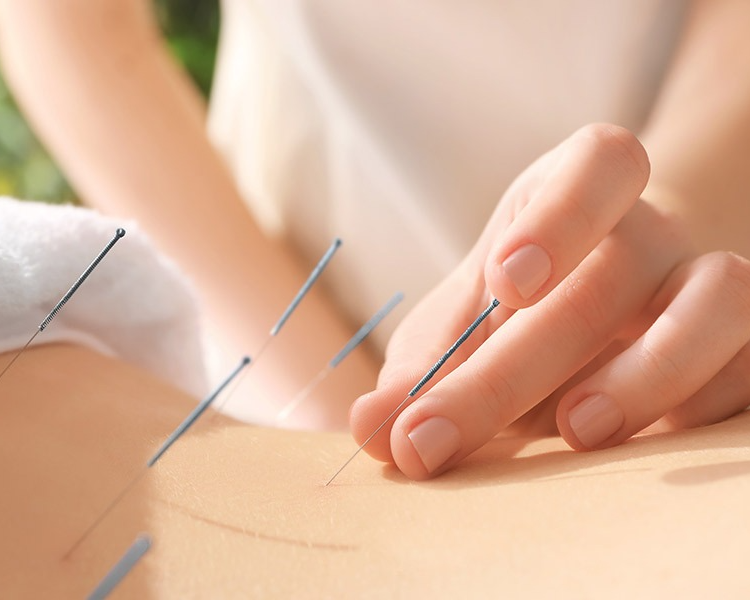 Pack de Acupuntura y Auriculoterapia