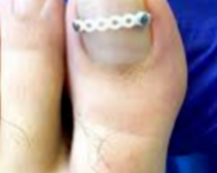 Revisión tratamiento y/o braquet (ortonixia)