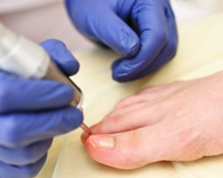 Terapia láser para Onicomicosis