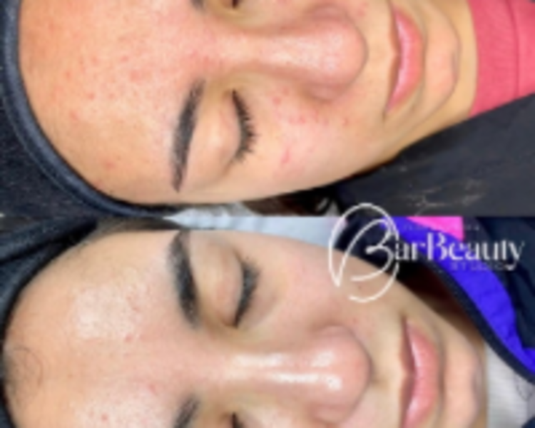 Limpieza Facial Adolescentes 