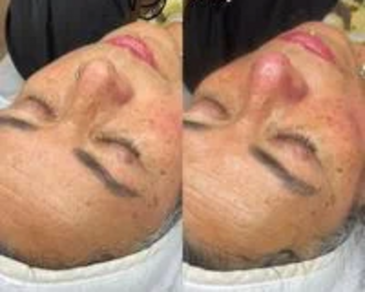 Evaluación Facial + Limpieza Recomendada 