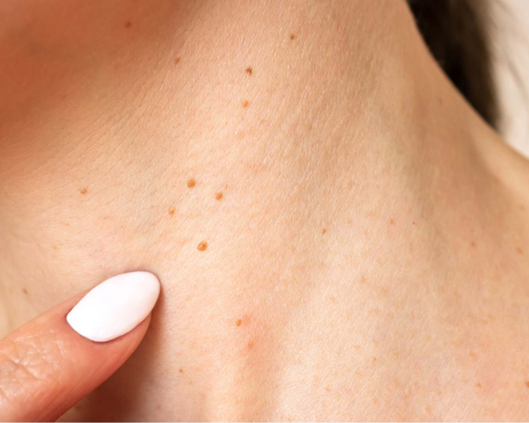 EXTRACCIÓN DE VERRUGAS