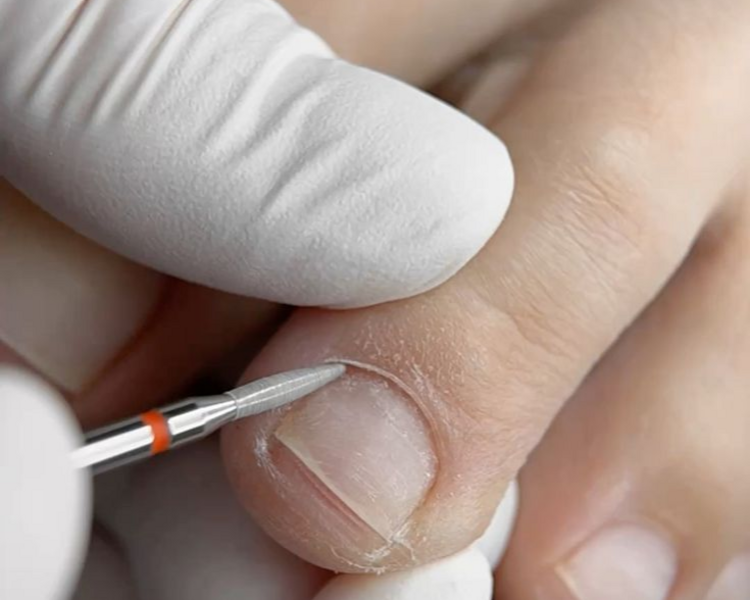 Retiro semipermanente pies