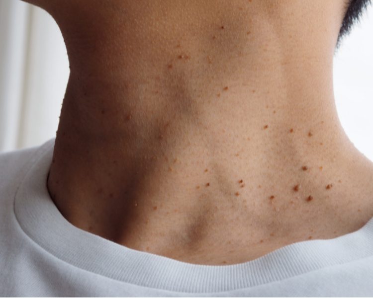  TRATAMIENTO VERRUGAS GENITALES / PAPILOMAS CUTANEOS/ACROCORDONES 