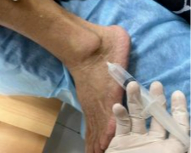 Infiltaciones Bilaterales Tobillos / Bilateral Ankle Infiltrations ( 5 sesiones ) 