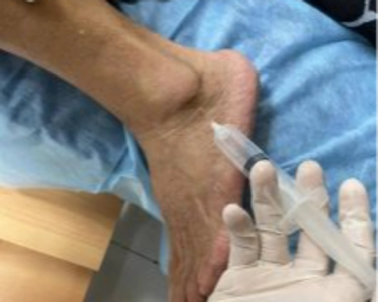 Infiltaciones Unilateral Tobillos / Unilateral Ankle Infiltrations 