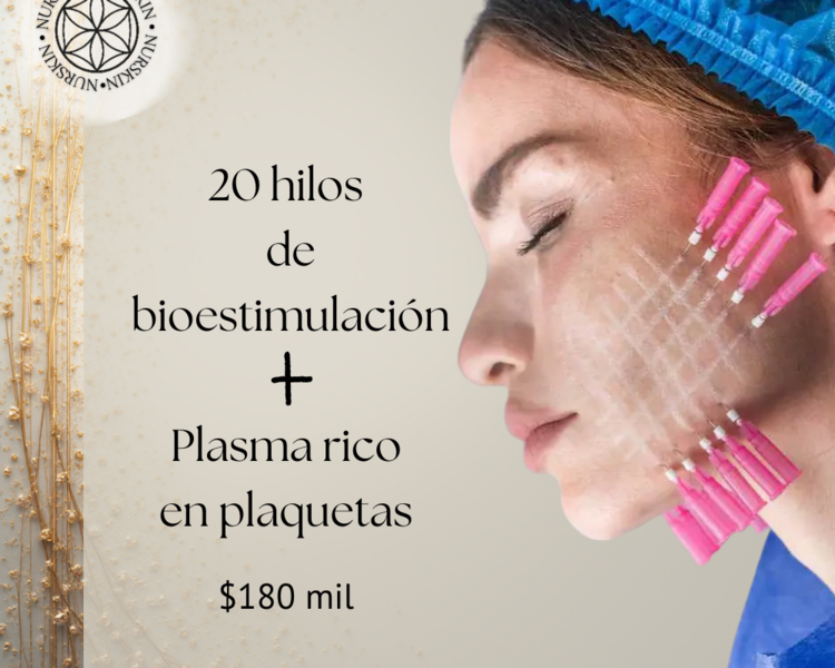 20 hilos de Bioestimulación + Plasma rico en plaquetas
