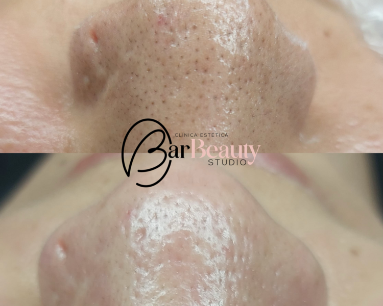  Limpieza Facial Profunda 