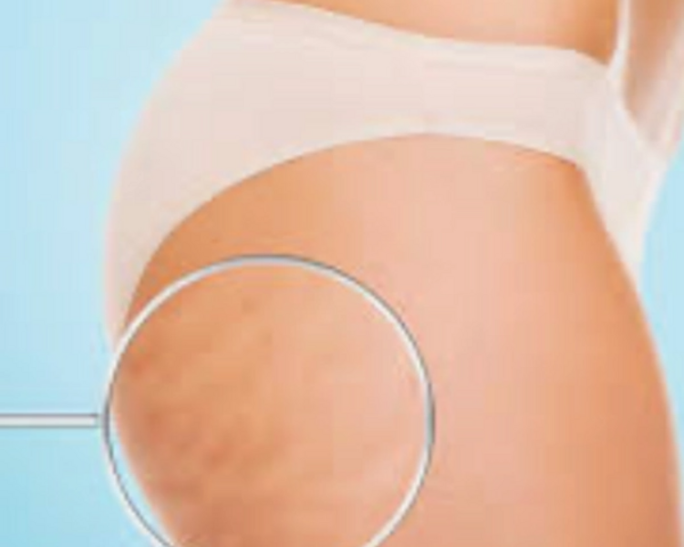 Celulitis Tratamiento de Ozono/ Cellulitis Ozone Treatment