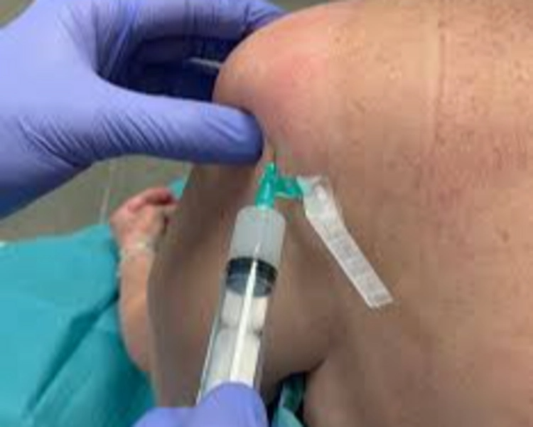 Infiltraciones de Triamcinolona en Ambas Articulaciones