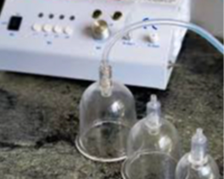 Ventosas Tratamiento de Ozono ( 5 sesiones)