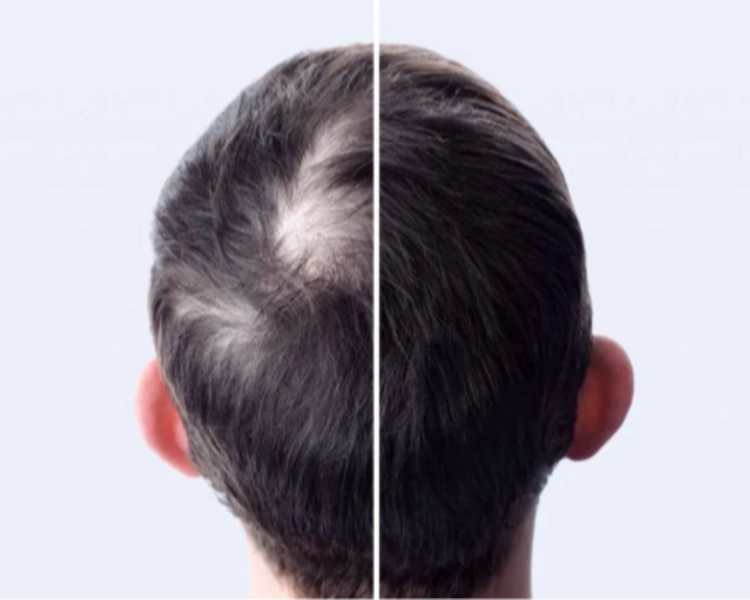 Embolado Capilar 5 Sesiones