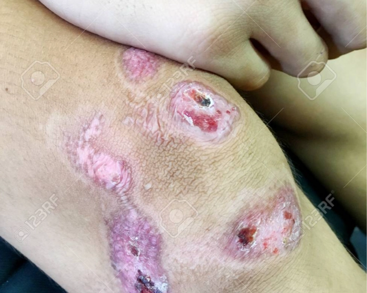 Infiltraciones Perilesionales OZONO ( 10 sesiones)