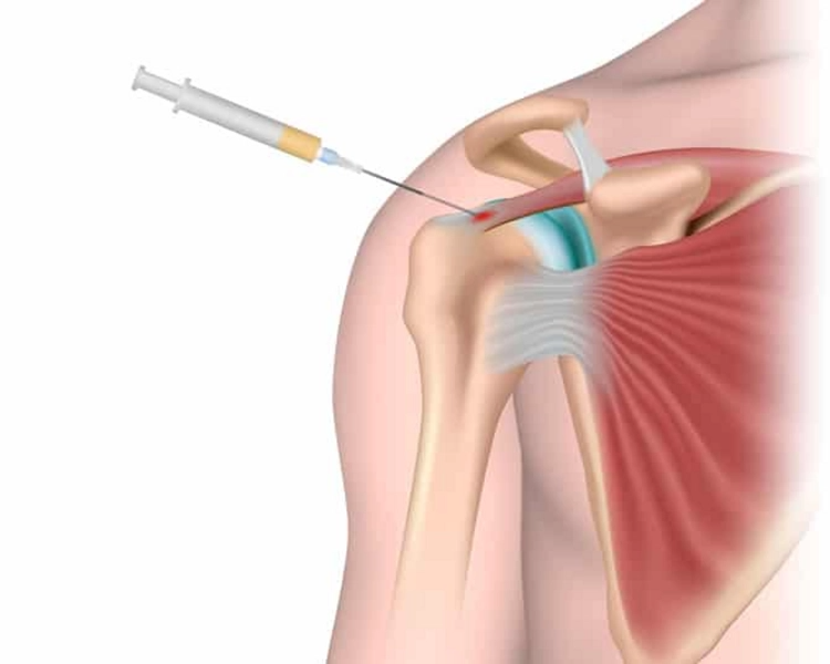 Infiltraciones de Triamcinolona 