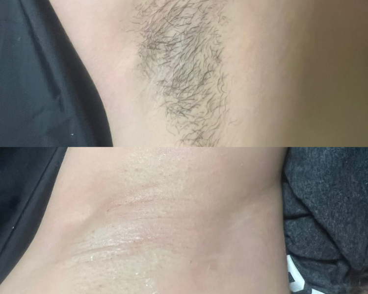 Depilación de axilas 
