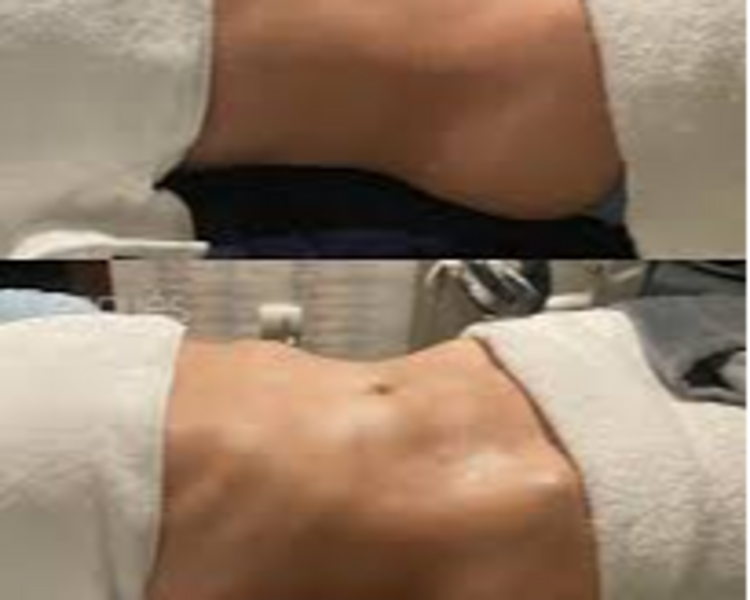 Linfat: Descongestión Abdominal y Modelación
