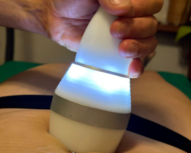 Crioradiofrecuencia corporal