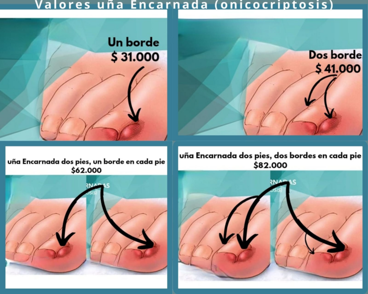 Uña Encarnada Bilateral (ambos bordes)