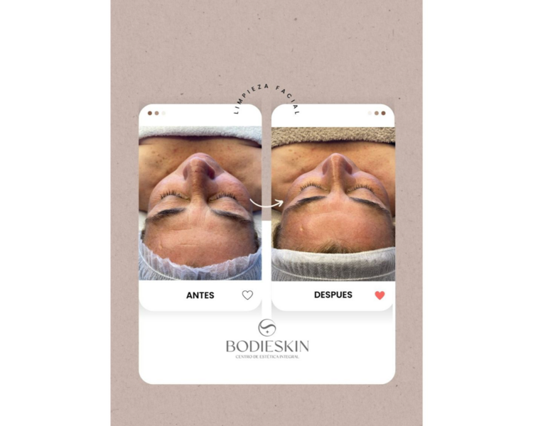 Limpieza Facial Profunda