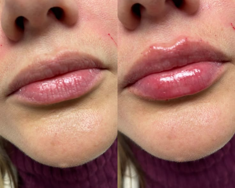 Relleno de Labios con Ácido Hialurónico (Promo exclusiva)