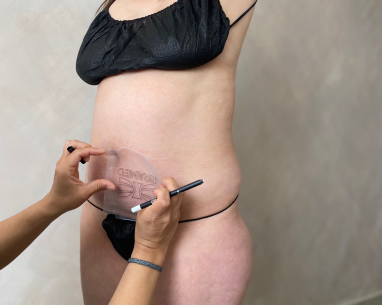 Evaluación corporal para tratamiento criolipólisis