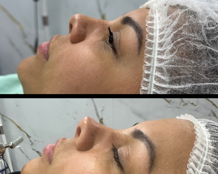 Rinimodelación (Promo exclusiva)