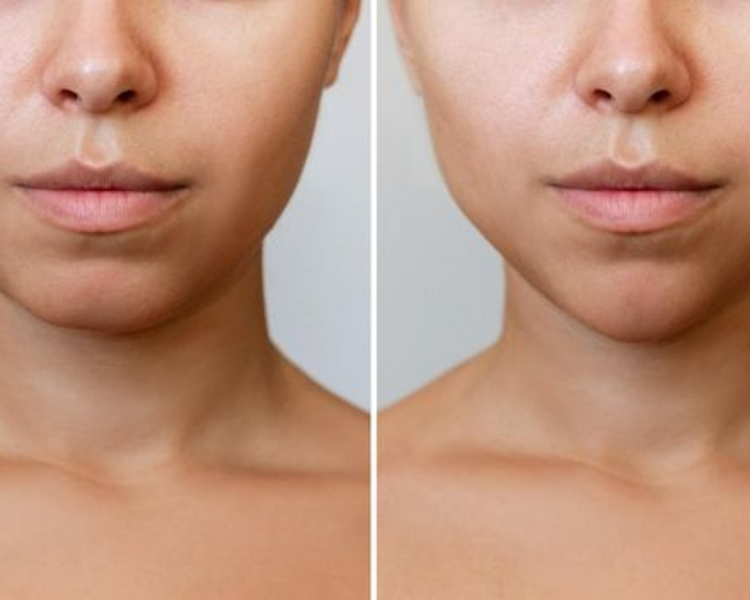 Relleno y modelación de Mentón (Promo exclusiva)