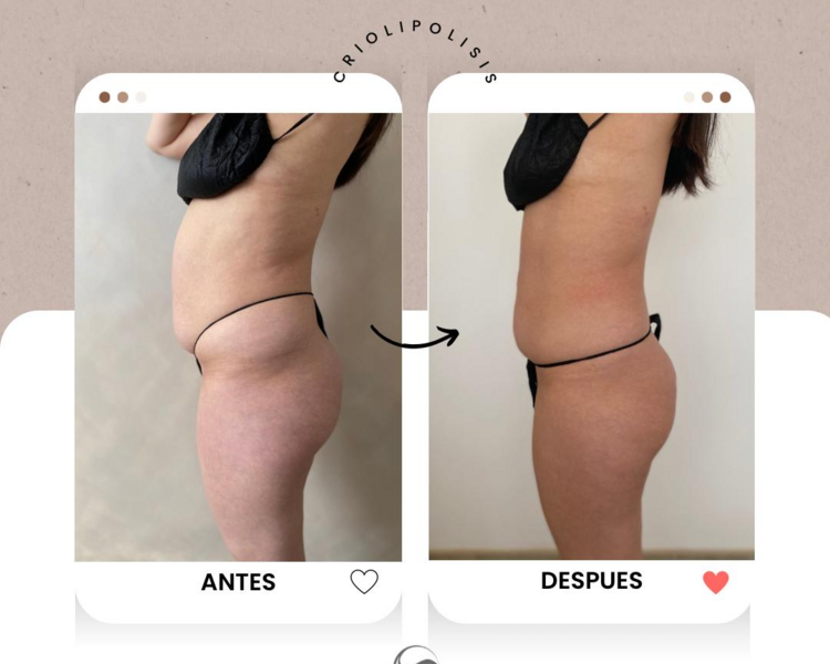 Criolipolisis Full Body Bodieskin