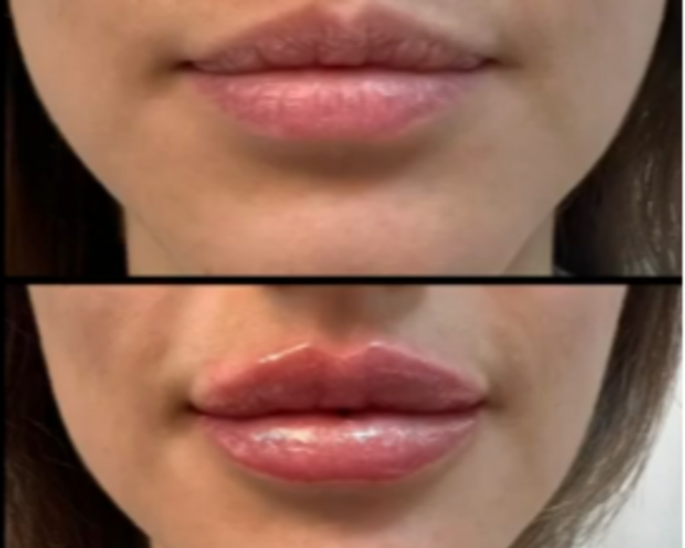 Relleno de labios (incluye retoque)