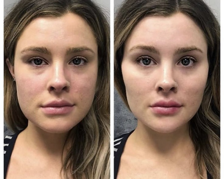 Proyección de Pómulos (2ML Valor exclusivo)