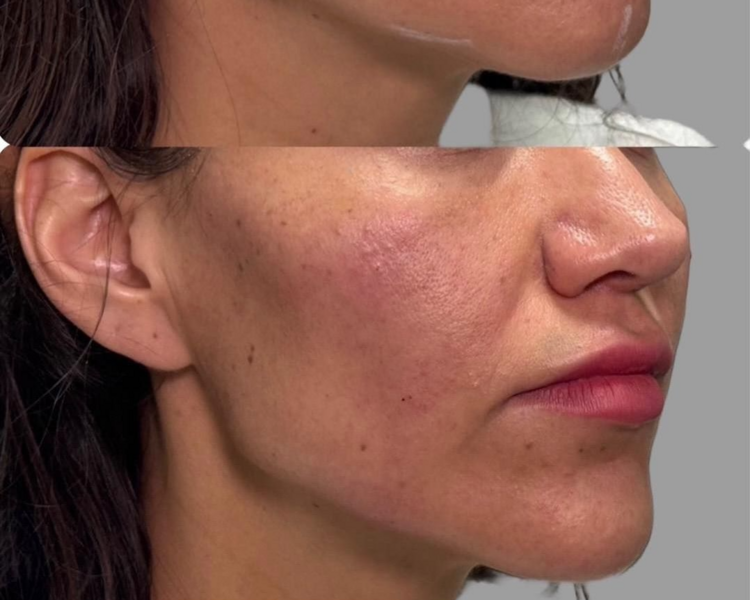 Reborde Mandíbular con Ácido Hialurónico (Valor por ML)