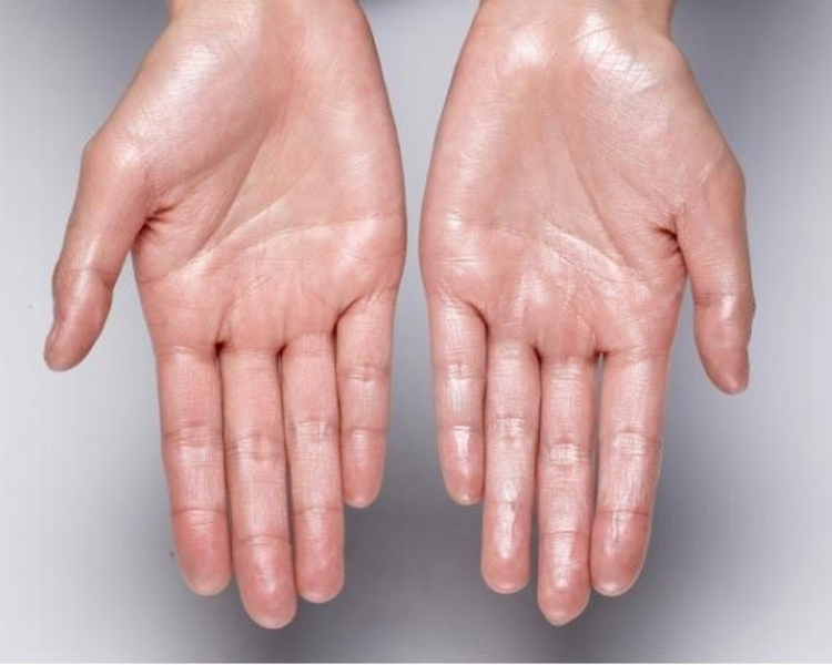 Botox Tratamiento de Hiperhidrosis 