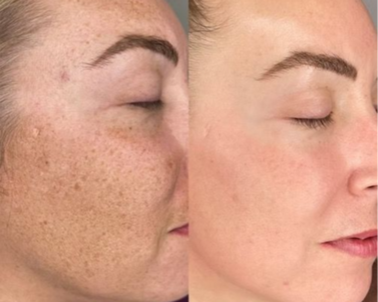 Limpieza facial + Peeling Despigmentante