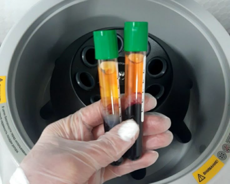 Plasma Rico en Plaquetas Capilar