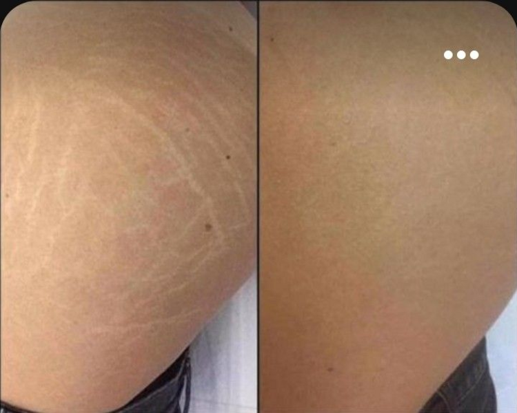 Camuflaje de estrías sin tinta