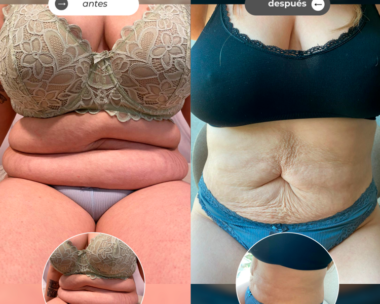 💥OFERTA CRIOLIPO Abdomen completo o espalda👙