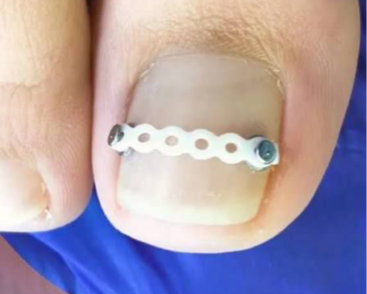 Atención domiciliaria para tratamiento de corrección para onicocriptosis (una encarnada) o láminas de forma involuta.