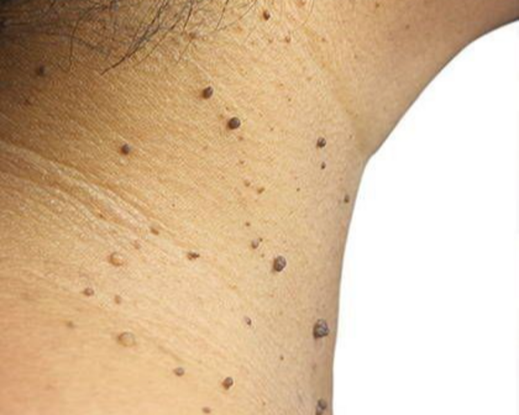 Extración de Acrocordones pequeños 