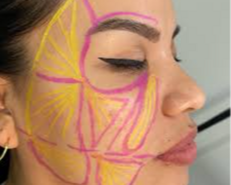 Adipoestructuración Facial + Papada (1sesión)