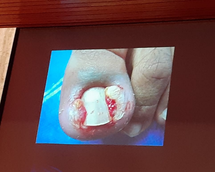 ATENCIÓN DE UÑA ENCARNADA BILATERAL