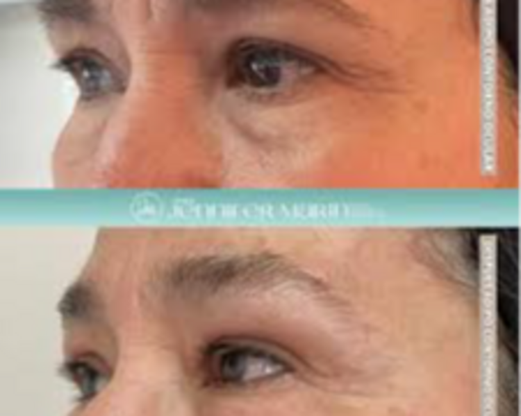 Adipoestructuración Contorno Ocular (1sesión)