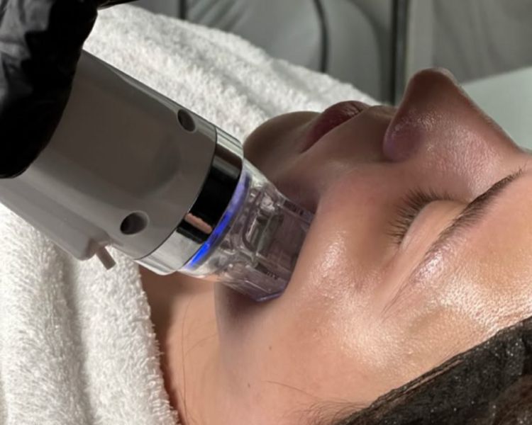 Radiofrecuencia Fraccionada Facial (1sesión)