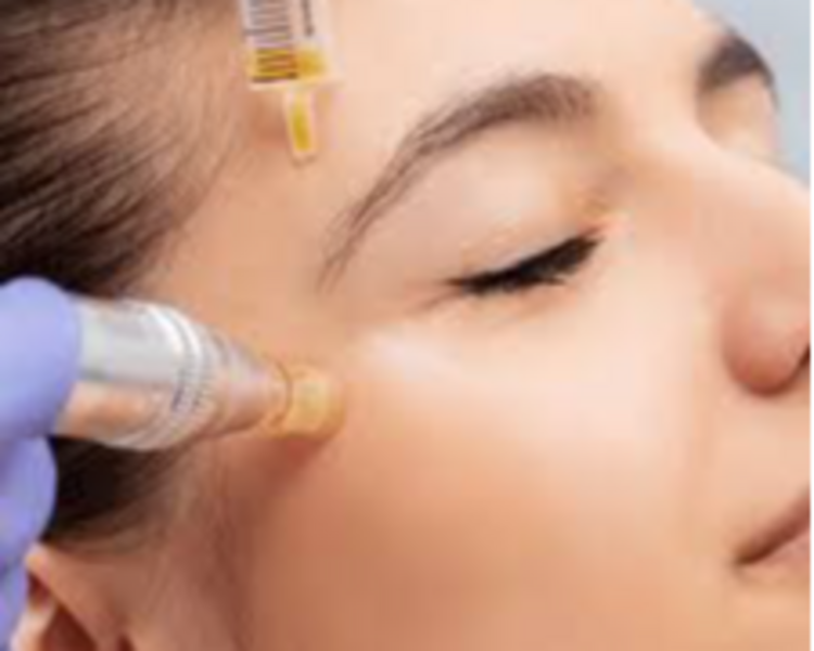 LIMPIEZA FACIAL + PLASMA RICO EN PLAQUTAS 