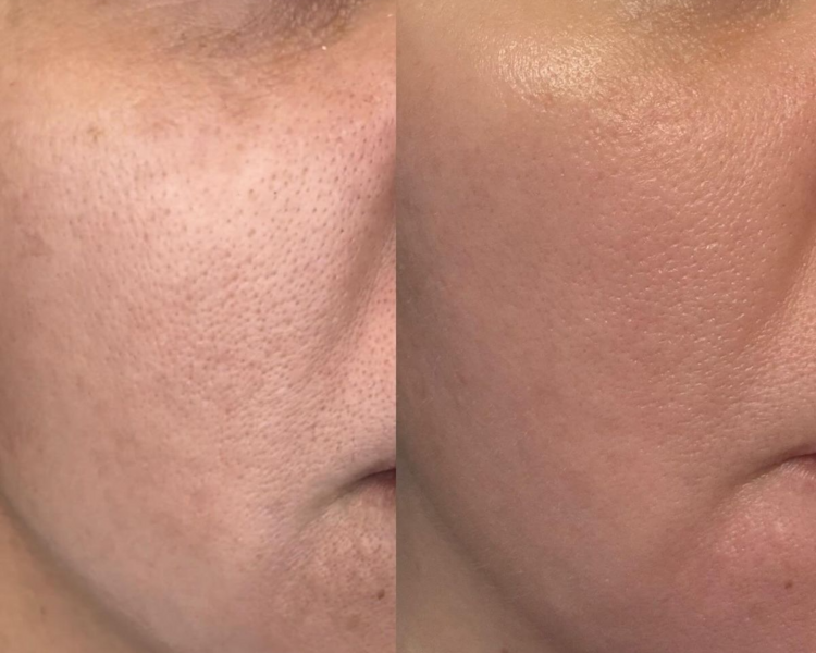 Limpieza facial profunda-Piel Mixta