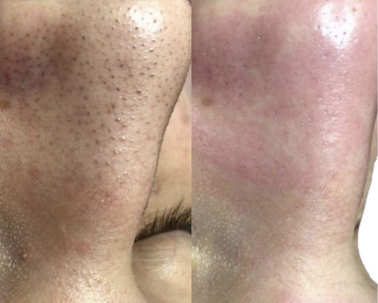 Limpieza facial profunda-Piel Grasa