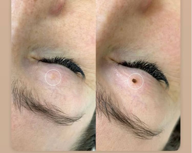 Cauterización de lunares x3