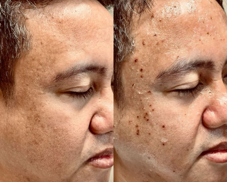 Cauterización de lunares x10