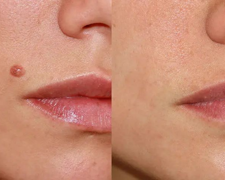 Cauterización de lunares/verrugas +10