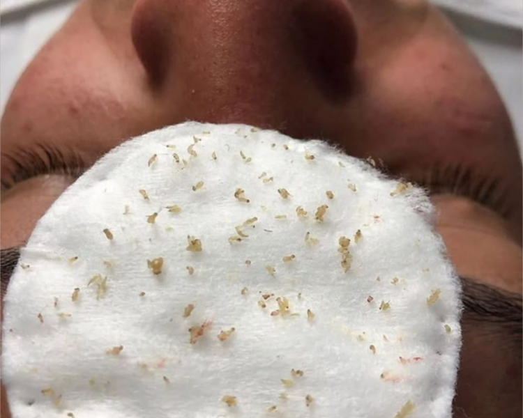 EXTRACCIÓN DE COMEDONES (PUNTOS NEGROS) + LIMPIEZA FACIAL