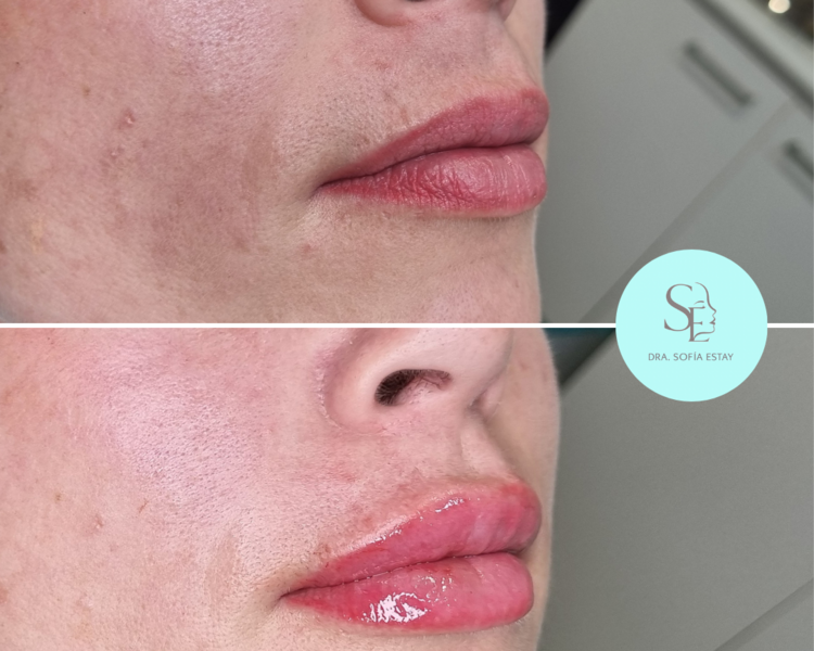 Aumento y perfilado de labios